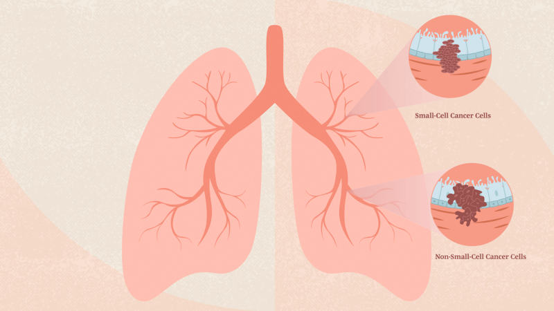 types-of-lung-cancer-alt-1440x810